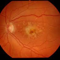 Recomendaciones para prevenir la degeneración macular asociada con la edad. 